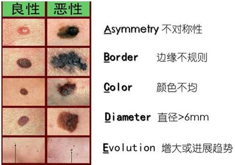 如何分辨痣的好壞|如何分辨痣的好坏？ 医生告诉你5个重点